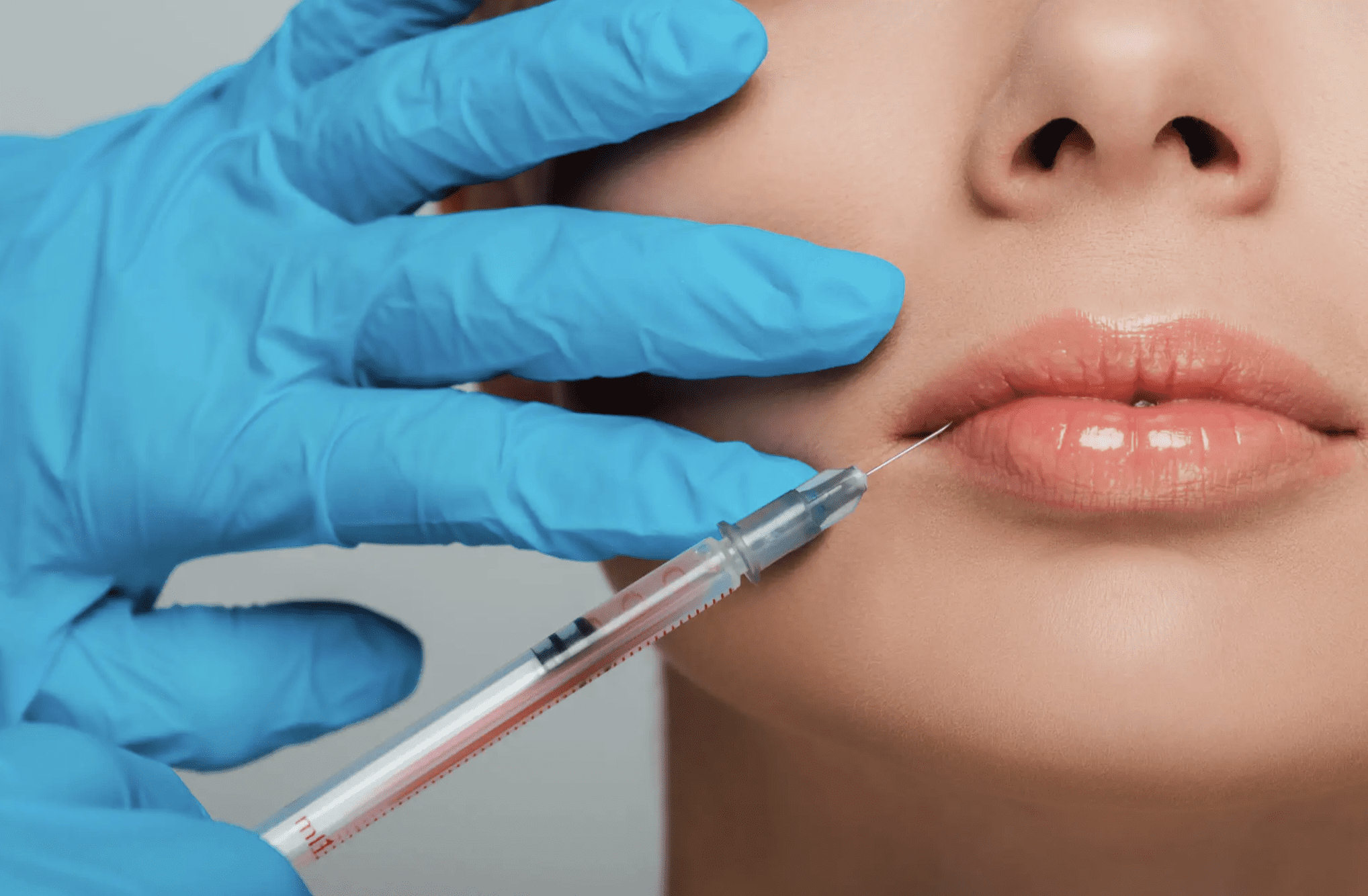 Close-up of a cosmetic lip injection procedure.