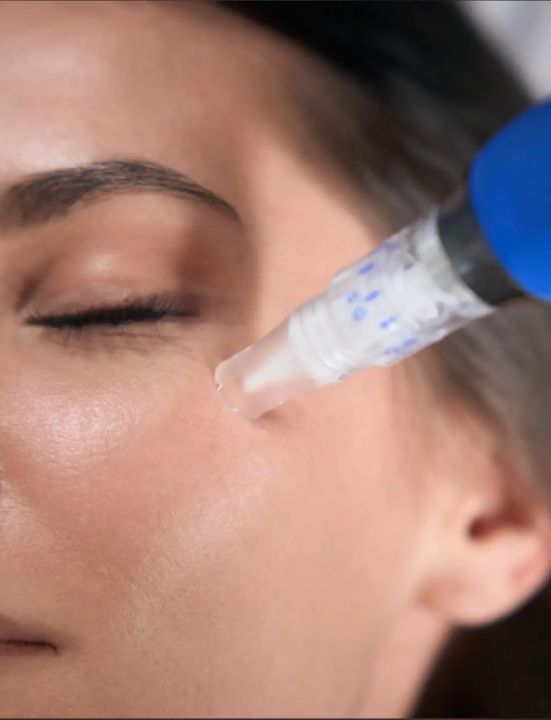 Close-up of a person receiving a cosmetic injection near the eye.