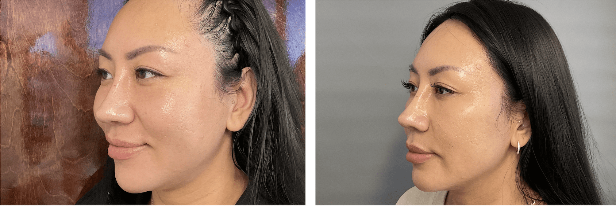 Facial Balancing PureSkin Aesthetics