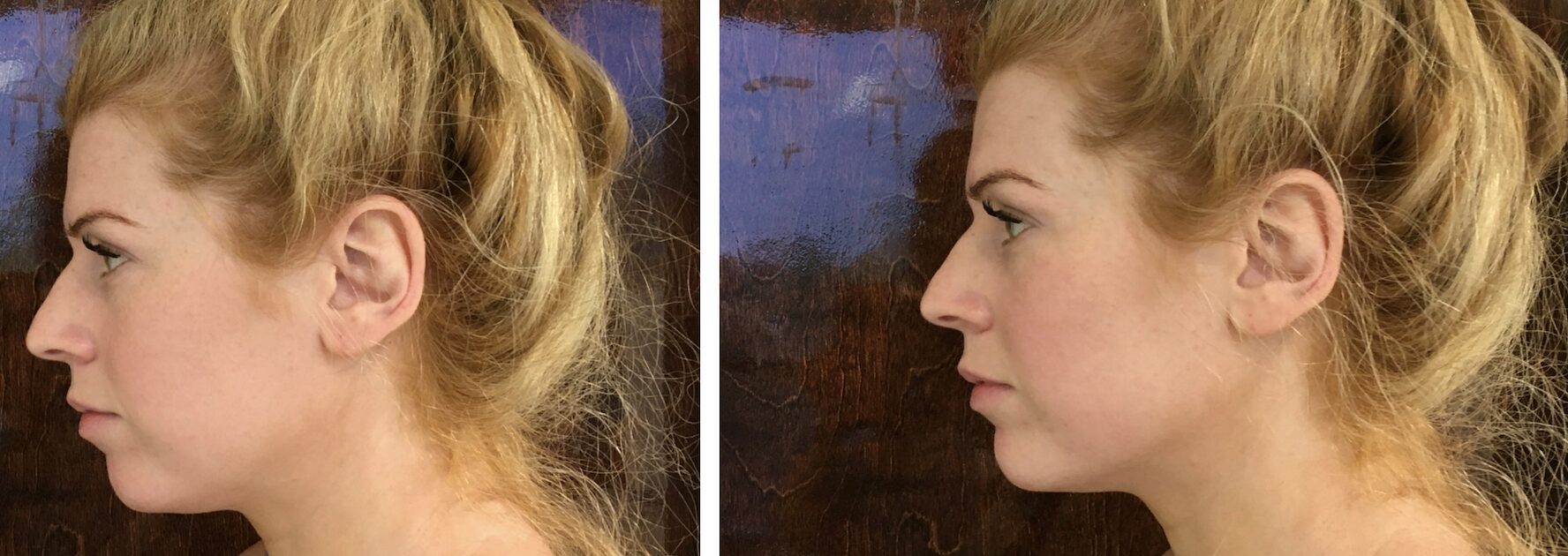 Facial Balancing PureSkin Aesthetics