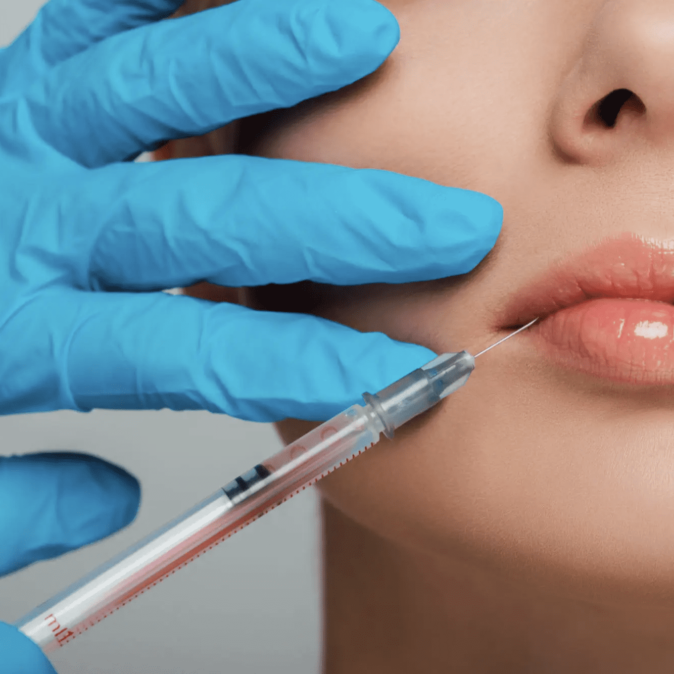 Close-up of a cosmetic lip injection procedure.